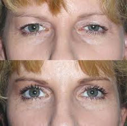 Blepharoplasty Eye Surgery