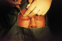 Chinese Eye Surgery