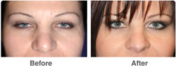 Cosmetic Eye Surgery