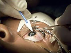 Eye Surgery Clinics