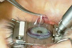 Lasik Eyes Eye Surgery