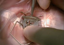 Vision Correction Eye Surgery