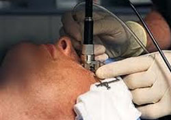 Wavefront Eye Surgery