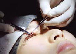 Why Can't I have Eye Surgery